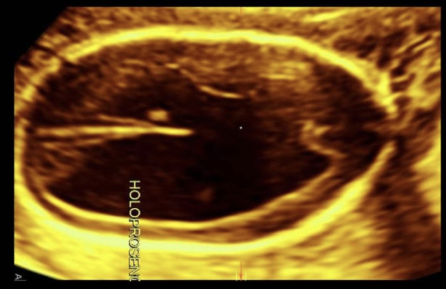 <p>a cephalic index of 70% in a 28w fetus indicates</p><p>a) dolichocephaly</p><p>b) brachycephaly</p><p>c) micrognathia</p><p>d) macroglossia</p>