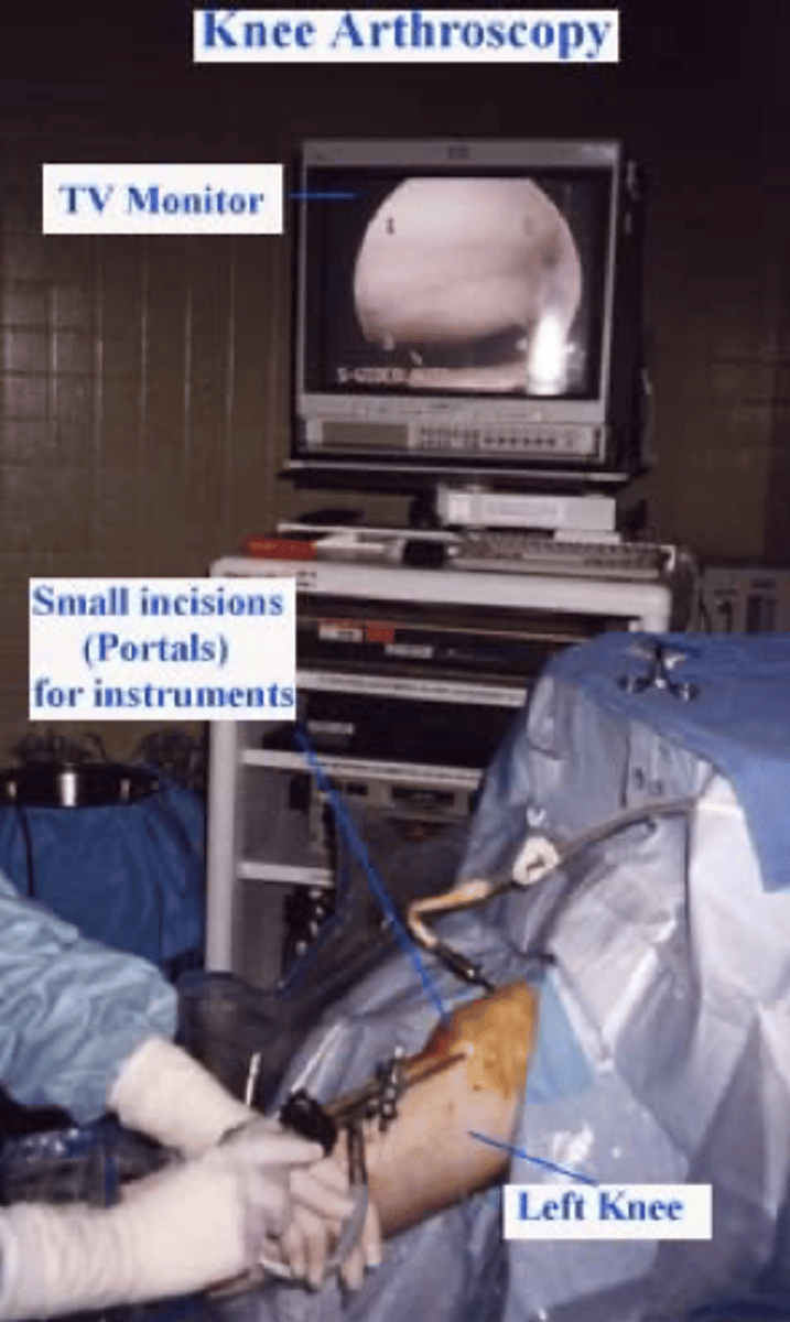 <p>1. camera</p><p>2. irrigating instrument (lets in sterile saline)</p><p>3. trimming instrument</p>