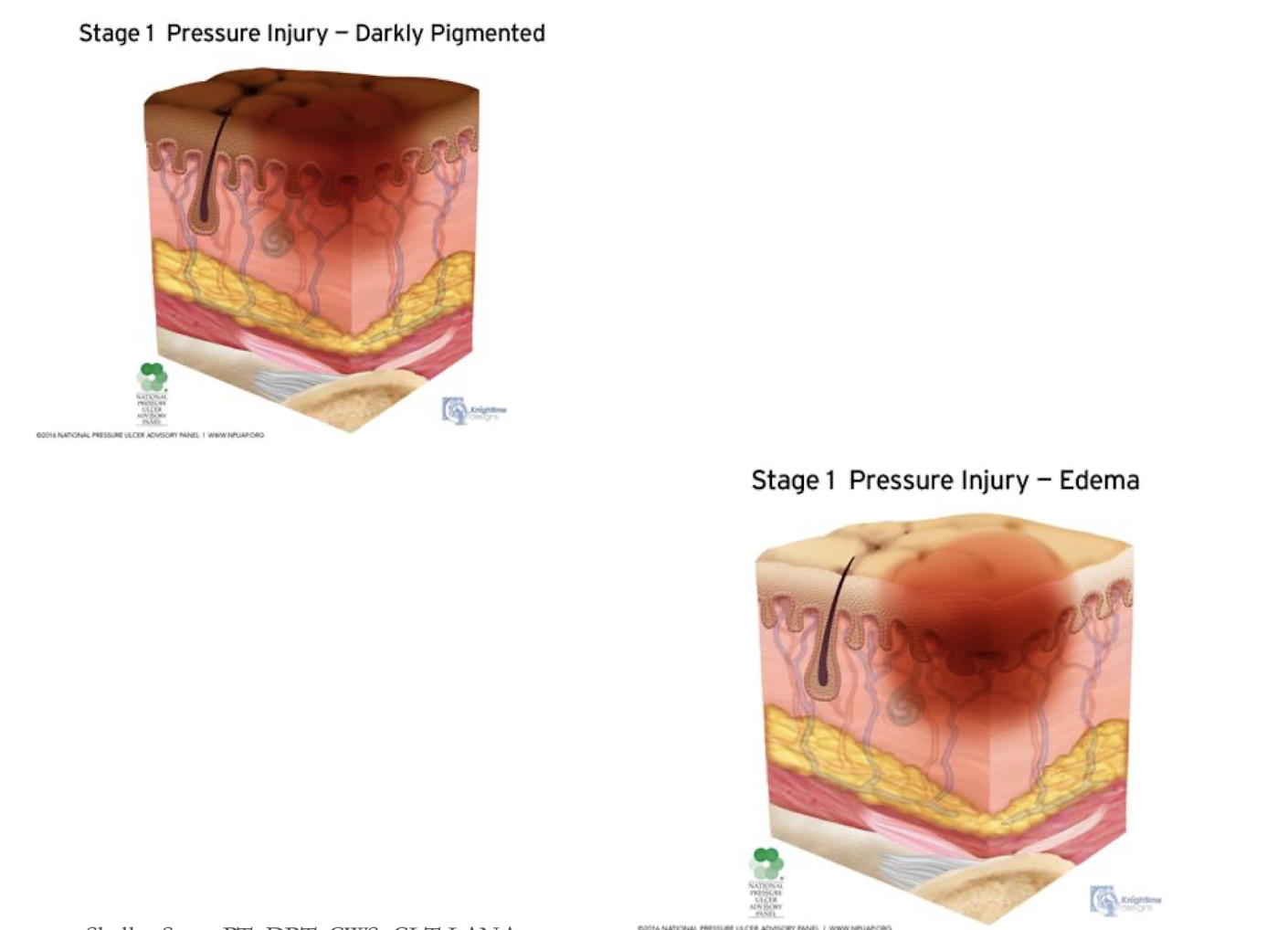 <ul><li><p><strong><u>Non-Blanchable erythema of intact skin</u></strong></p></li><li><p>Presence of:</p><ul><li><p>Blanchable Erythema</p></li><li><p>Changes in Sensation, Temp, Firmness</p></li></ul></li><li><p>Purple or Maroon</p><ul><li><p>Deep Tissue Injury</p></li></ul></li></ul><p></p>