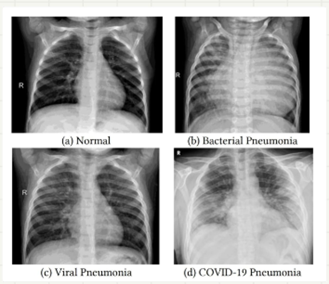 <p>pneumonia dx for all types</p>