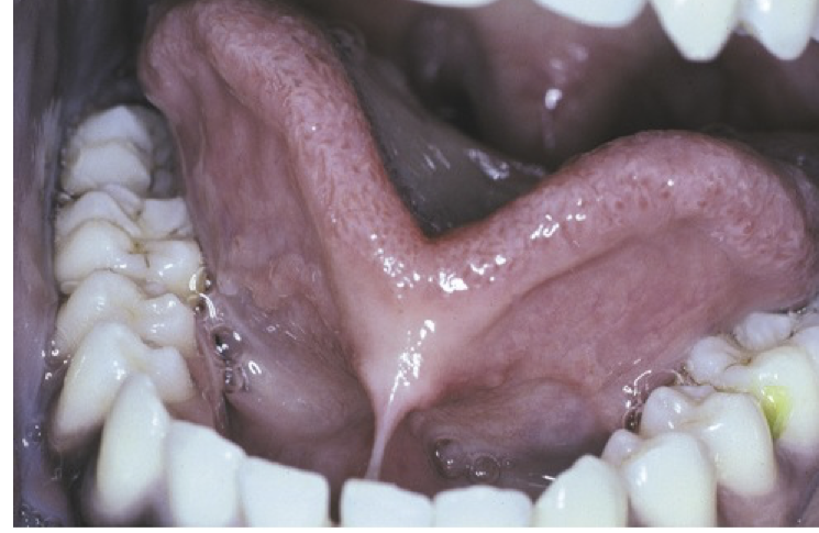<ul><li><p>Fusion of tongue to floor of mouth</p></li><li><p>Possible fusion of frenum to tip of tongue</p></li><li><p>Slight clefting of tongue tip</p></li><li><p><strong>Speech difficulties</strong> (usually minor)</p></li></ul><p></p>