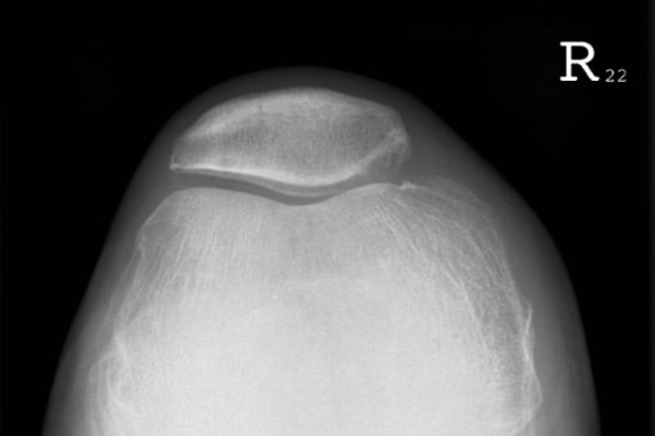 <p>relationship of patella to anterior femur</p>