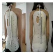 <ul><li><p>Presence of posterior uprights</p></li><li><p>T10-T12</p></li><li><p>The TLSO low-profile scoliosis orthoses provide dynamic action using three principles (end-point control, transverse loading, and curve correction) to prevent curve progression and to stabilize the spine.</p></li></ul><p></p>