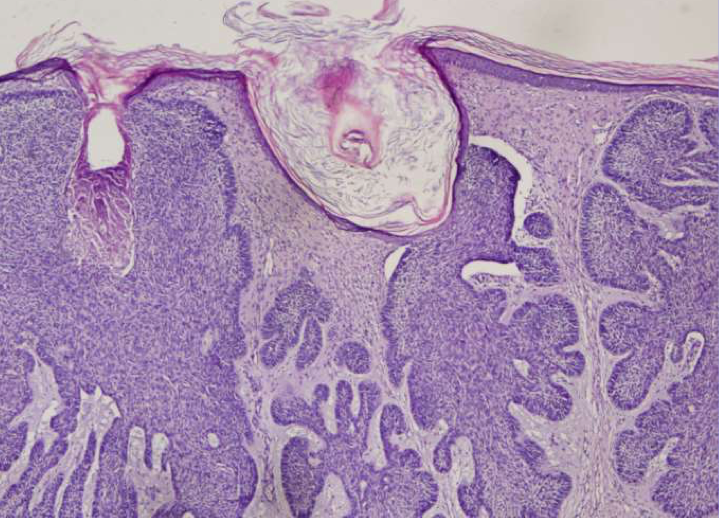 <p>Que montre l’image où la tumeur envahit le derme ?</p>