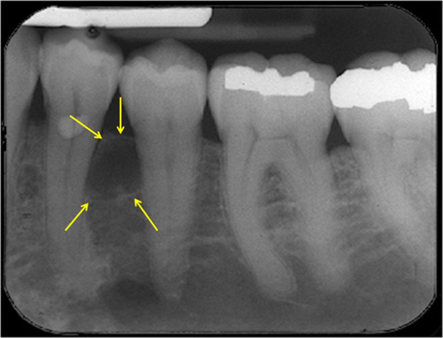 <p>- Location: Originates in the supporting structures of the tooth, specifically the periodontal tissues (gums, periodontal ligament, and bone) rather than within the tooth itself.</p><p>- Cause: Typically occurs due to gum disease (periodontitis), where bacteria accumulate in periodontal pockets around the tooth, leading to infection, inflammation, and the formation of an abscess.</p><p>- Symptoms: Symptoms may include localised swelling, redness, pain, and tenderness in the affected gum area. Sometimes, there might be pus drainage from the gum pocket.</p><p>- Treatment: Treatment involves drainage of the abscess, deep cleaning (scaling and root planing) to remove bacterial deposits and infected tissue, and sometimes surgical intervention to access and clean the affected area.</p>