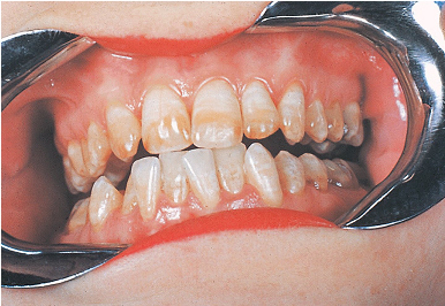 <p>fluorosis.</p><p>Fluorosis occurs from ingestion of a high concentration of fluoride during tooth development. The teeth affected by fluorosis are generally decay resistant. Hutchinson incisors are a result of congenital syphilis. A Turner tooth is the result of infection from a deciduous tooth. Attrition is the result of the wearing away of tooth structure during mastication.</p>
