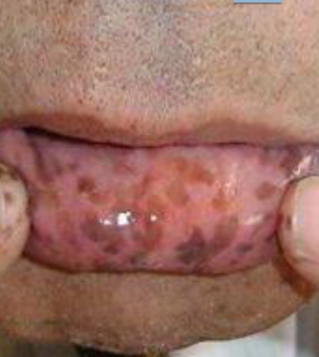 <p>freckle like brown lesions on lips, buccal mucosa, tongue, and extremities </p>