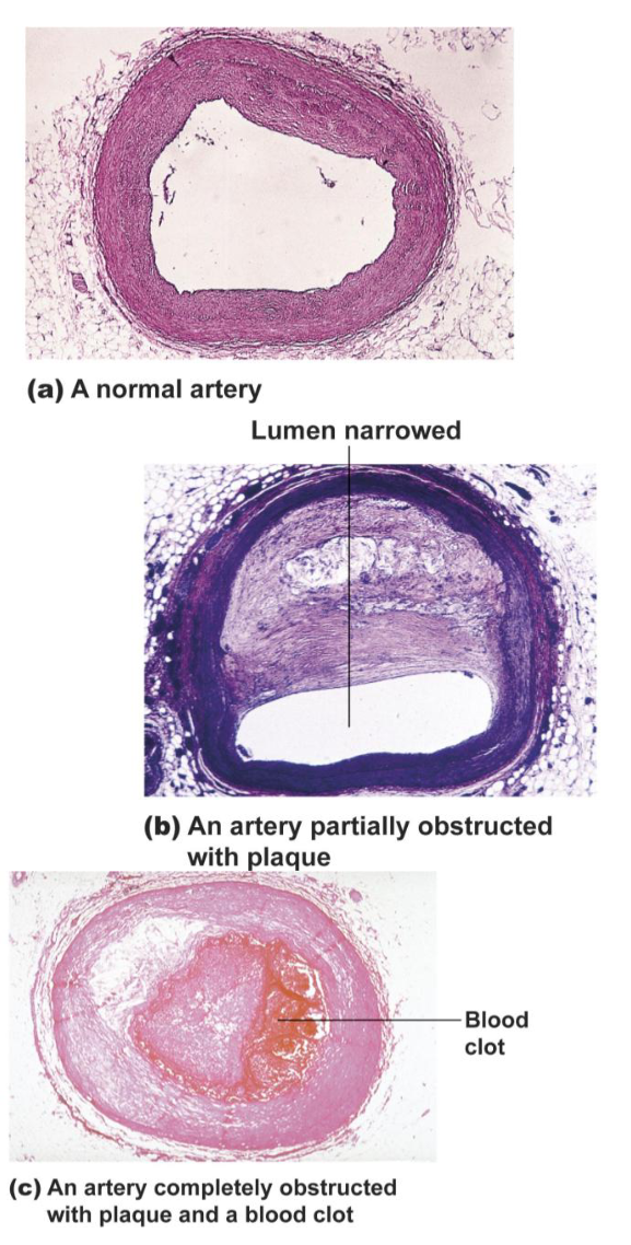 <ul><li><p><span><span>Narrowing of arteries due to calcified fatty deposits (plaque) and thickening of the wall</span></span></p></li><li><p><span><span>Triggered by damage to arterial wall<br>(inflammation!)</span></span></p></li><li><p><span><span>Can lead to heart attack or stroke</span></span></p></li><li><p><span><span>When this occurs in the arteries of heart muscle, it is called coronary artery disease</span></span></p></li></ul><p></p>