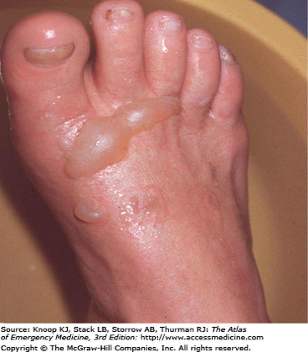 <p>A circumscribed elevation of the epidermis containing clear fluid &gt;1 cm in diameter</p><p>- Ex: 2nd degree burn</p>