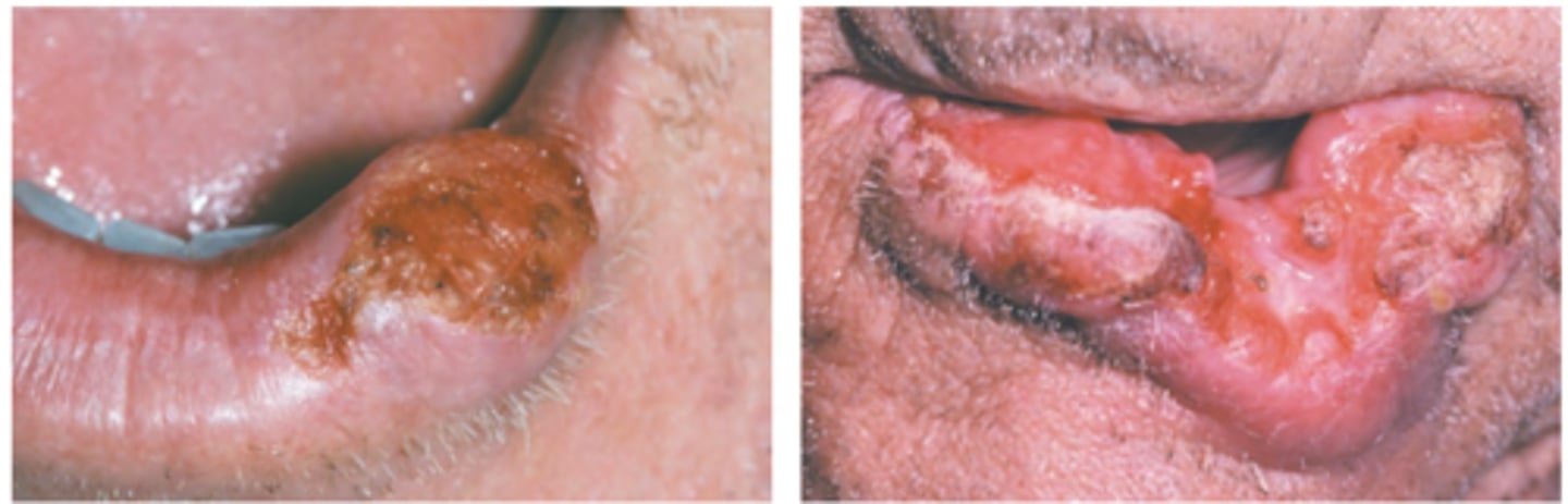 <p>Hint: 90% occurrences on lower lip - best prognosis</p>