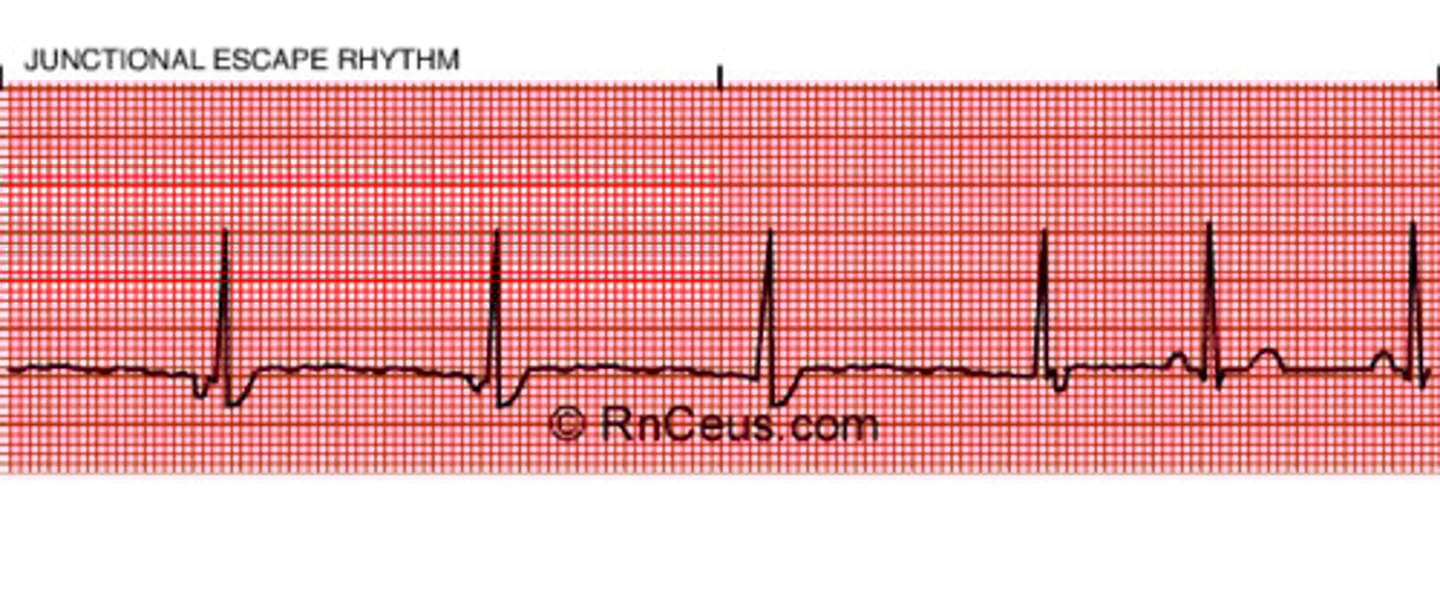 <p>rate: 40-60 typically</p><p>P waves: inverted, absent of retrograde</p><p>P-R: Normal, short, not applicable</p><p>QRS: Narrow usually,</p><p>Rhythm: regular</p>