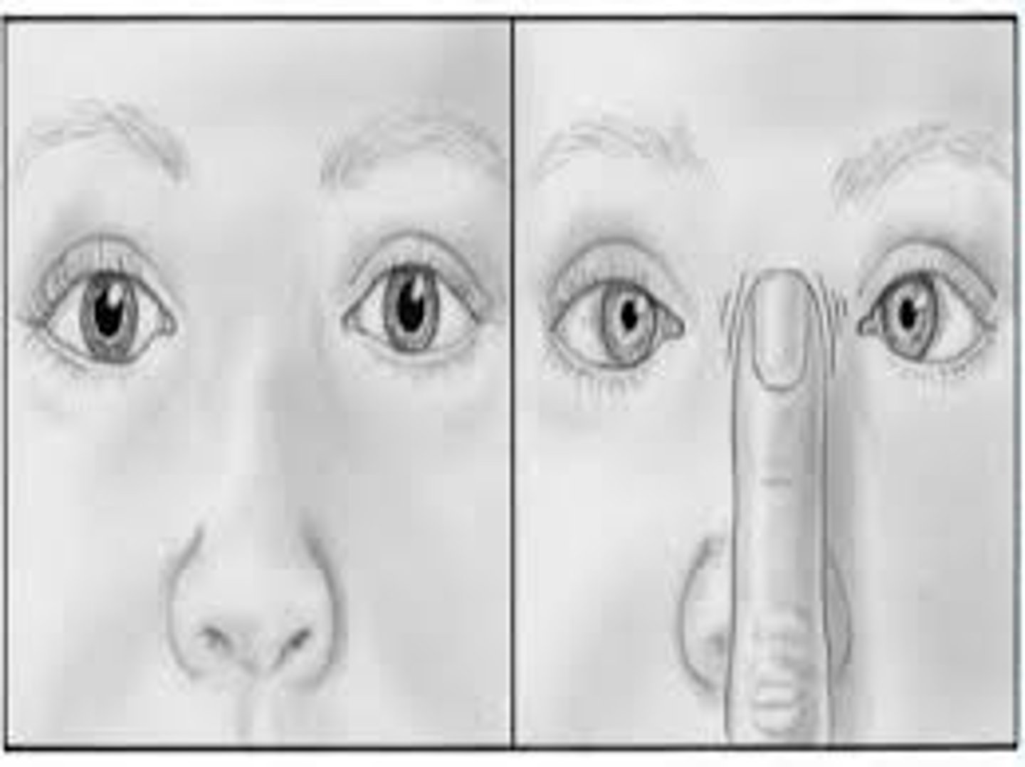 <p>-have pt look off into distance--dilates pupil and then put a finger in front of nose and watch pupil adjust/ constrict to see objects far away and close up</p>