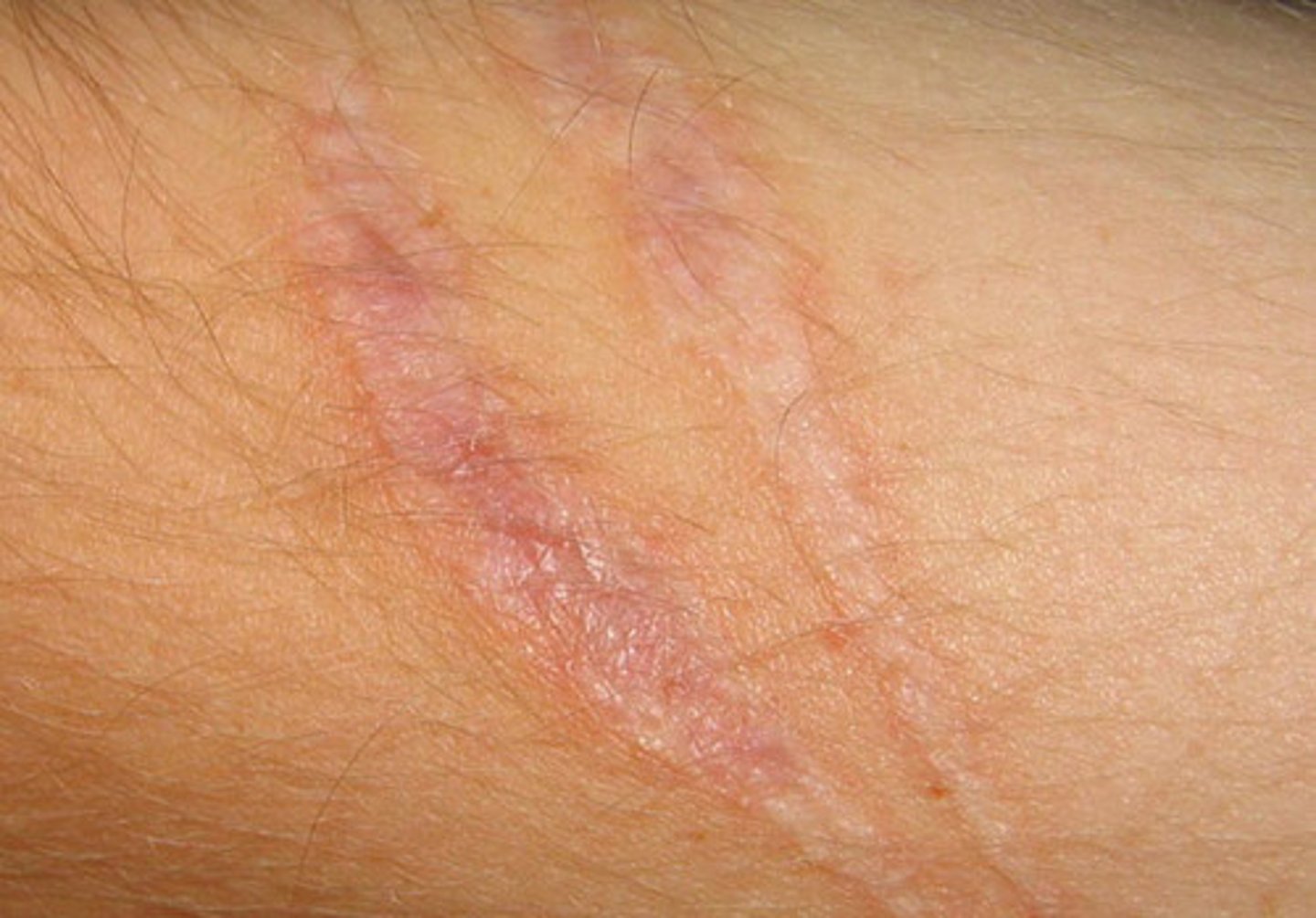 <p>The damaged tissue is replaced by scar tissue (non functional)</p>