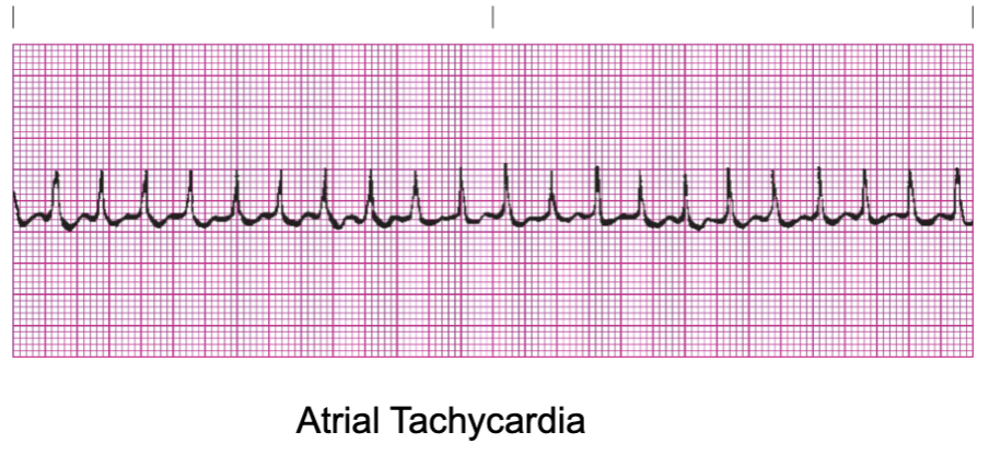 <ul><li><p>It means that the P wave occurred on or near the T wave and is thus obscured beyond clear identification</p></li><li><p><strong>UTA = unknown</strong></p></li><li><p><span style="color: green;"><strong>EX: Atrial Tachycardia&nbsp;</strong></span></p></li></ul><p></p>