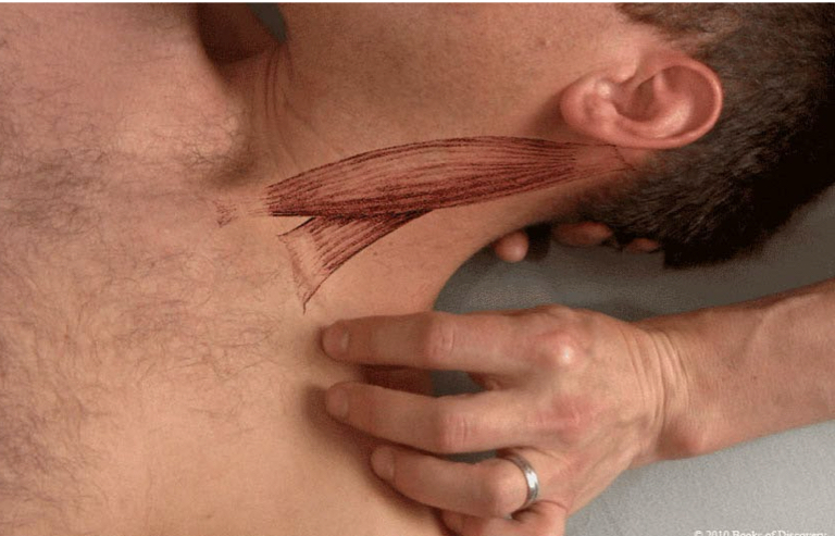 <p>Sternocleidomastoid</p>