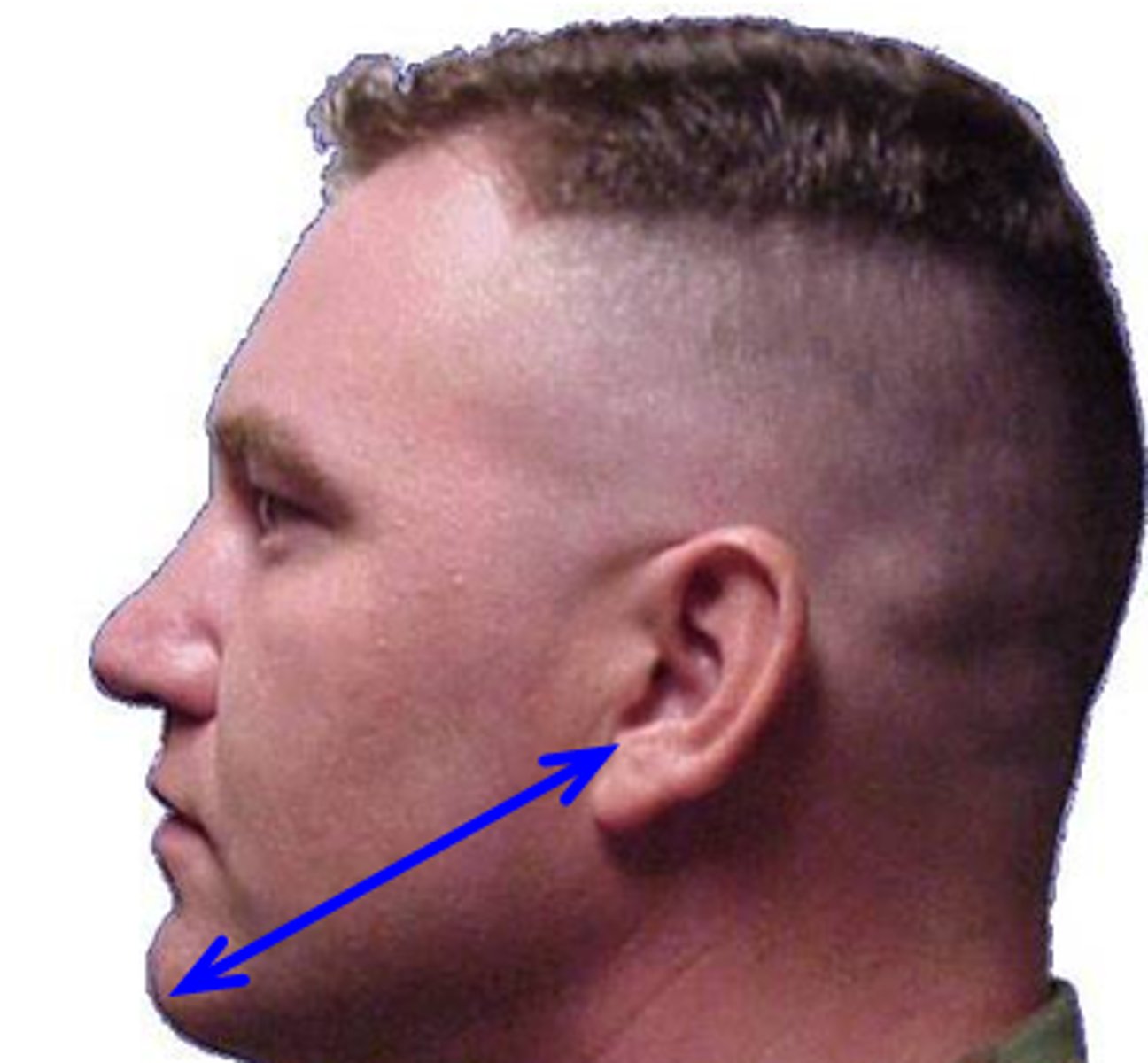 <p>Mentomeatal line</p>