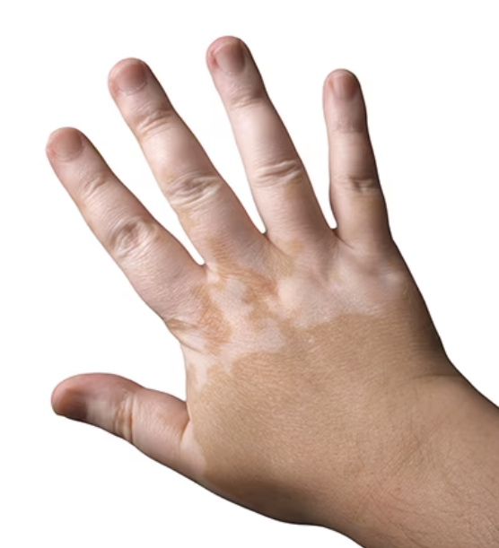 <p>what type of flat, primary skin lesion is this?</p>