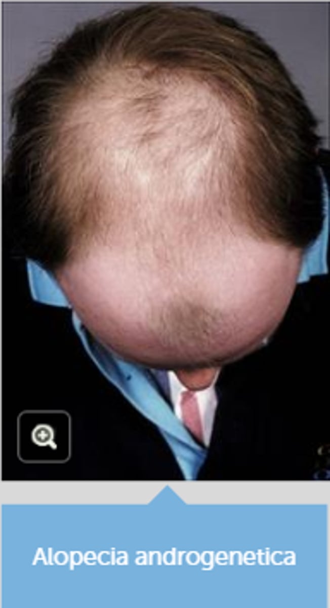 <p>= (fe)male patterned hair loss, is progressief haarverlies volgens een welbepaald patroon</p><p>- erfelijke factor</p><p>- androgeen</p>