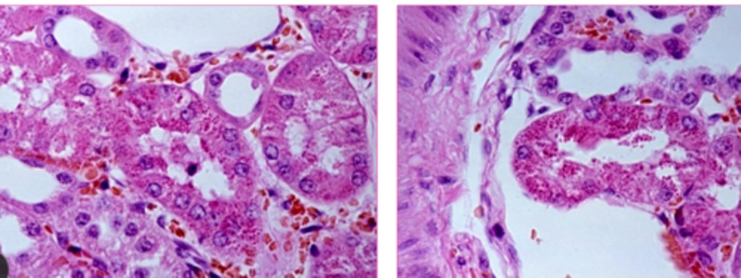 <p>cytoplasm of proximal renal tubular epithelial cells</p>