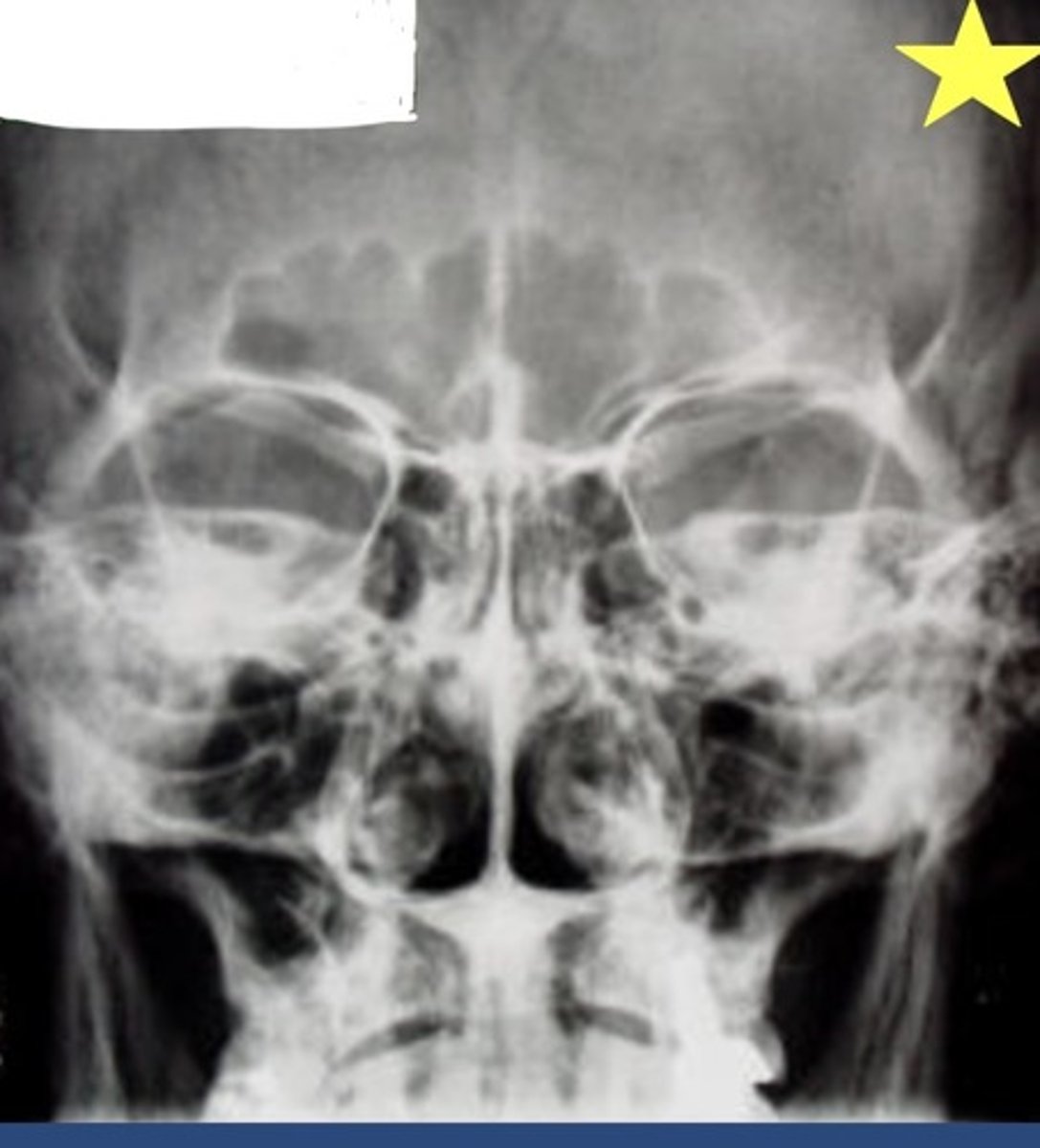 <p>What view was this radiograph shot in? Ensure you can locate the sinuses.</p>
