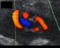 <p>When dopplering the umbilical artery, what flow type is considered normal?</p>