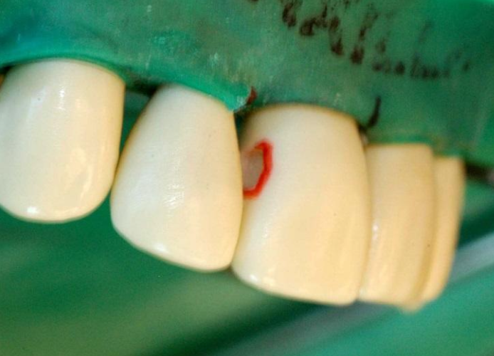 <ul><li><p>start preparation with #1 or #2 round carbide bur on proximal surface</p></li><li><p>enlarge outline form to obtain clear visualization of internal aspects of preparation</p><ul><li><p>facial wall is slightly crescent-shaped when viewed from facial aspect</p></li></ul></li><li><p>extend facial margin until all decay is removed, then bevel facial aspect of the preparation</p><ul><li><p>only beveled if it must be extended to facial embrasure due to decay</p></li><li><p>1mm wide bevel placed on facial margin </p></li></ul></li></ul><p></p>