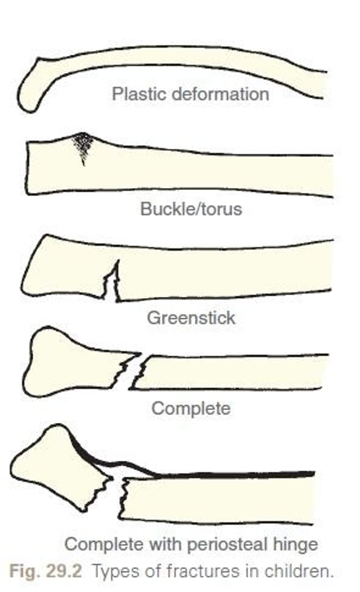 <p>A fracture where one side of the bone breaks and the other side bends</p>