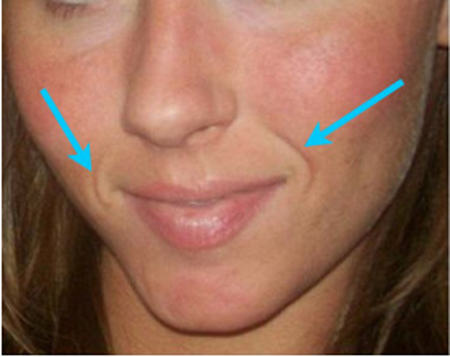 <p>skin crevice between the nose and the corner of the mouth</p>