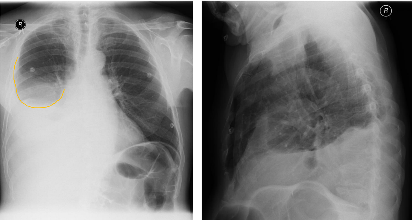 <p>Patient history: abdominal postoperative condition</p><p>Modality: PA (left) and lateral (right) chest radiograph; hard-beam technique (120–140 kV) </p><p>Region: chest, pleura</p><p>Radiologic sign: Decreased transparency at the right lung base showing a meniscus-shaped contour on the right side (yellow line).</p><p>Diaphragm and lateral sinuses cannot be differentiated on the right. Left side is normal.</p><p>Diagnosis: right-sided pleural effusion</p>