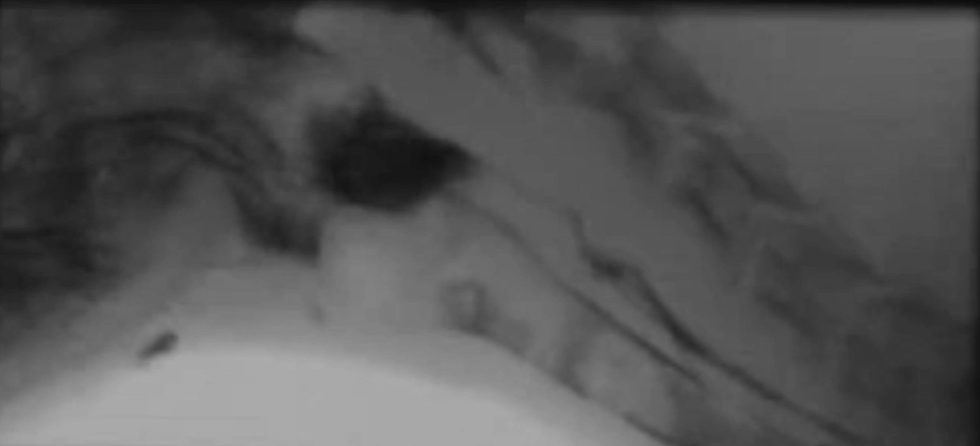 <p><u>swallow contrast videofluoroscopy</u></p><p>when diagnosed, rule out myopathy or polyneuropathy</p><p>(ddx: myasthenia gravis - AChR antibody titers; autoimmune myositis - CK, muscle bx; hypothyroidism - serum total thyroxine, TSH)</p>