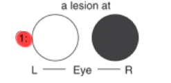 <p>Complete loss of the right eye </p>