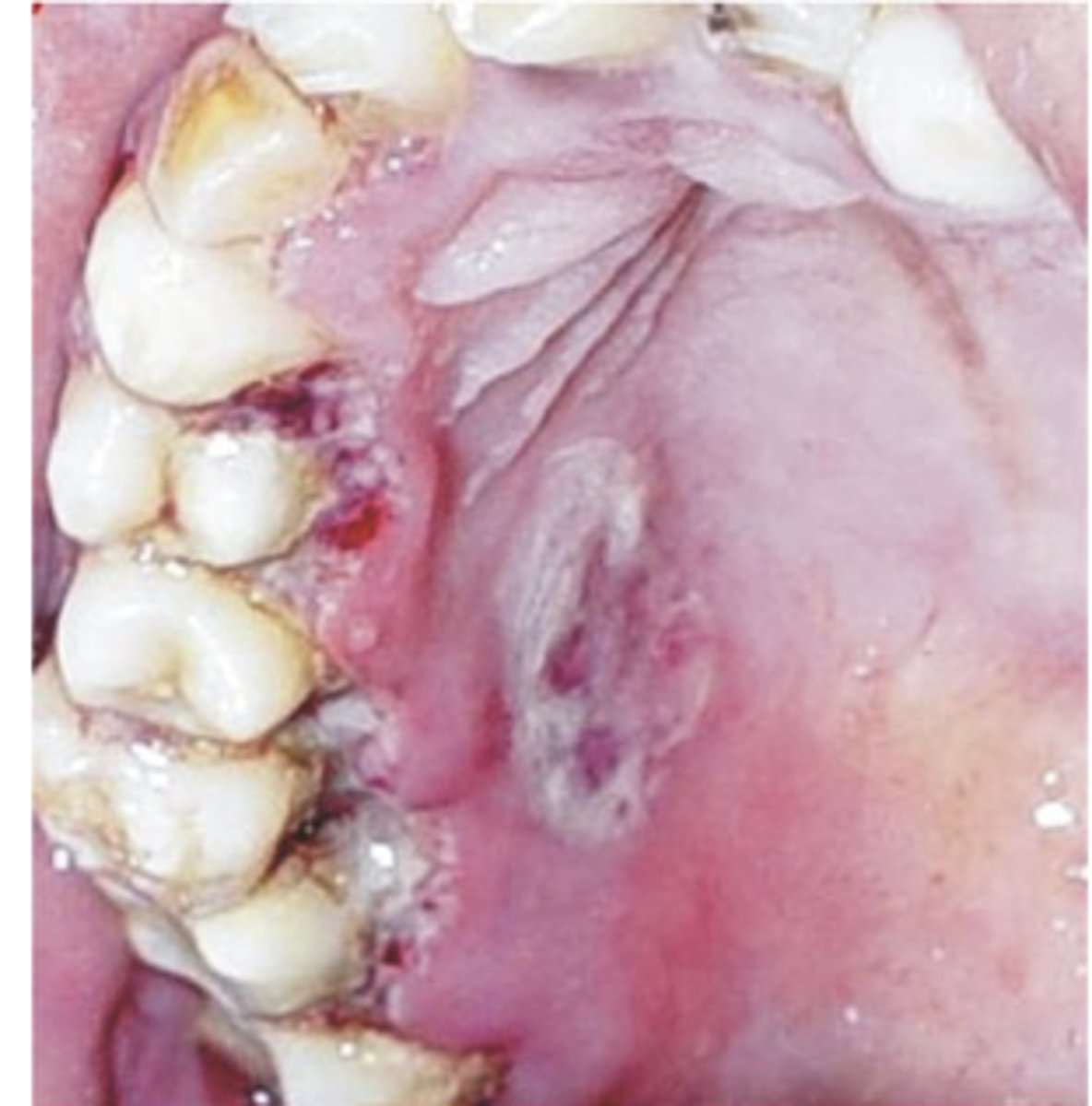 <p>Vincent disease (trench mouth)</p><p></p><p>Fever, malaise, lymphadenopathy</p><p>•Rapid onset gingival pain</p><p>--Necrosis in interdental papilla</p><p><strong>•Characteristic halitosis, altered taste</strong></p>
