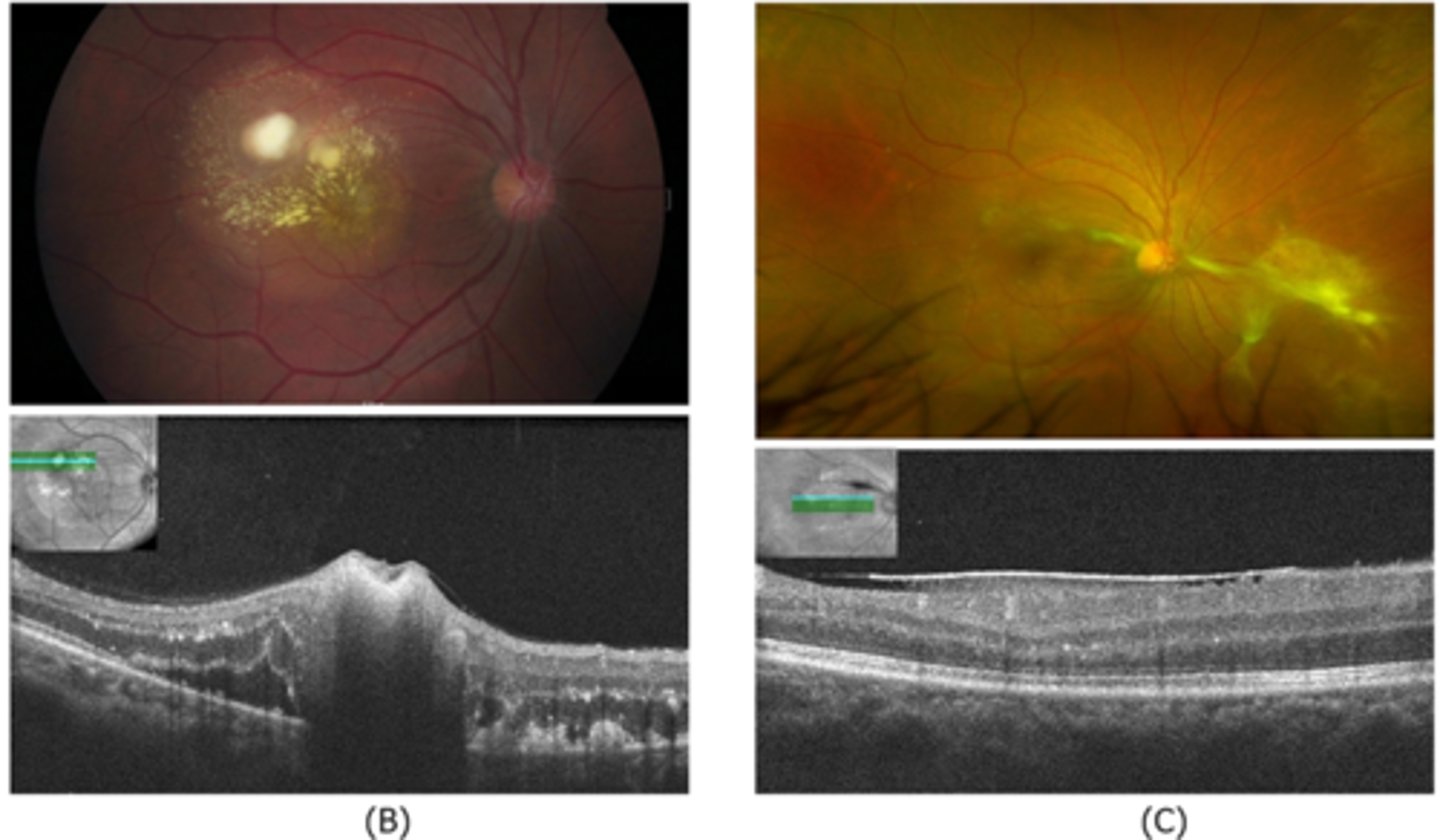 <p>granuloma now in nasal retina, fibrous memb where granuloma once was (looks like ERM)</p>