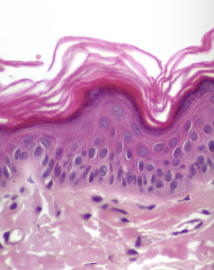 <p><strong>Thin skin</strong></p>