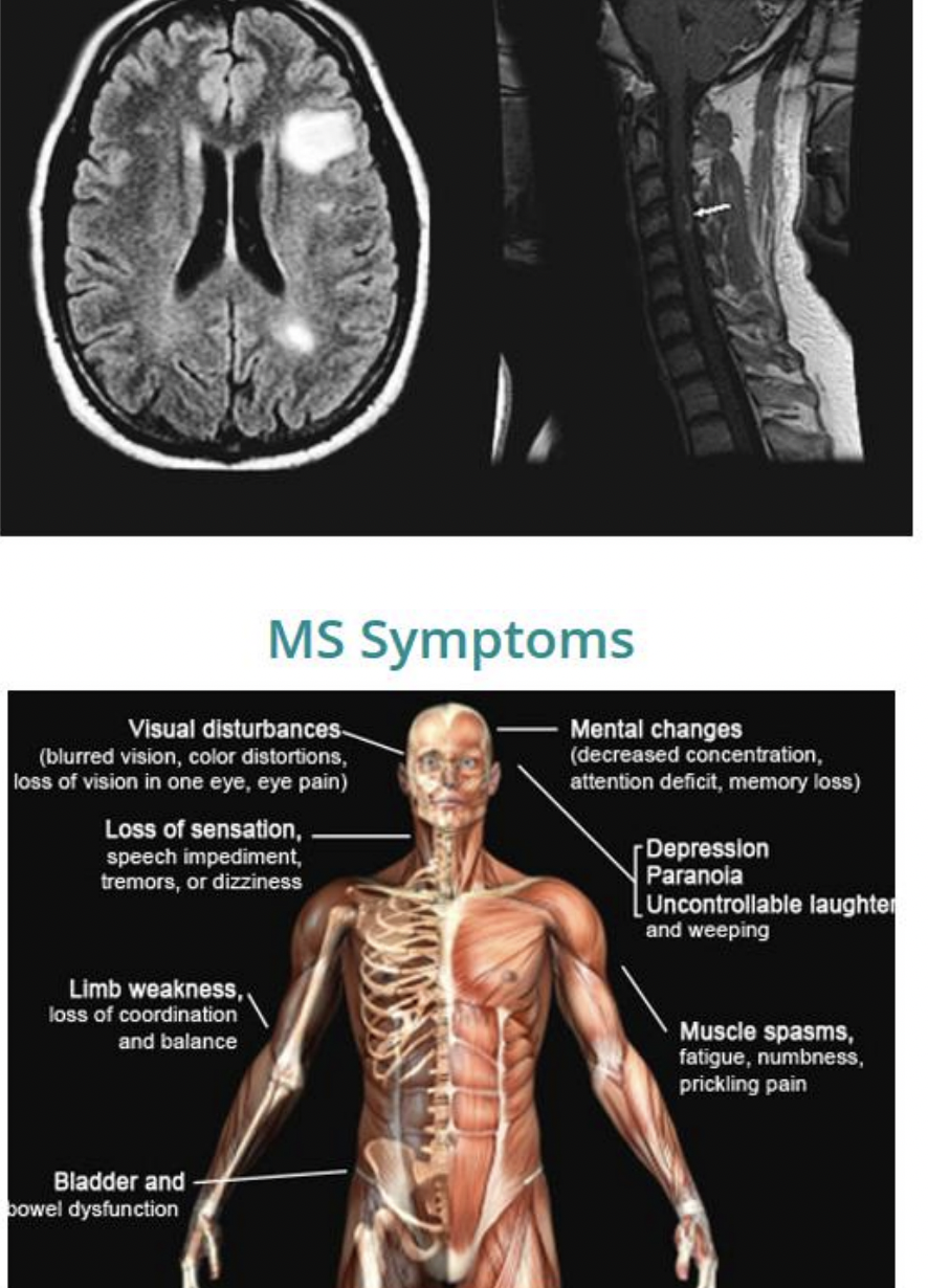 <ul><li><p>antibodies attack oligodendrocytes </p></li><li><p>produce sclerotic plaques in the white matter of the CNS</p></li><li><p>signs and symptoms</p><ul><li><p>weakness lack of coordination, impaired vision, double vision, impaired sensation, and slurred speech; may also disrupt of memory and emotions </p></li></ul></li><li><p>diagnosis is difficult: </p><ul><li><p>usually manifests with one sign that may completely resolve </p></li></ul></li></ul><p></p>