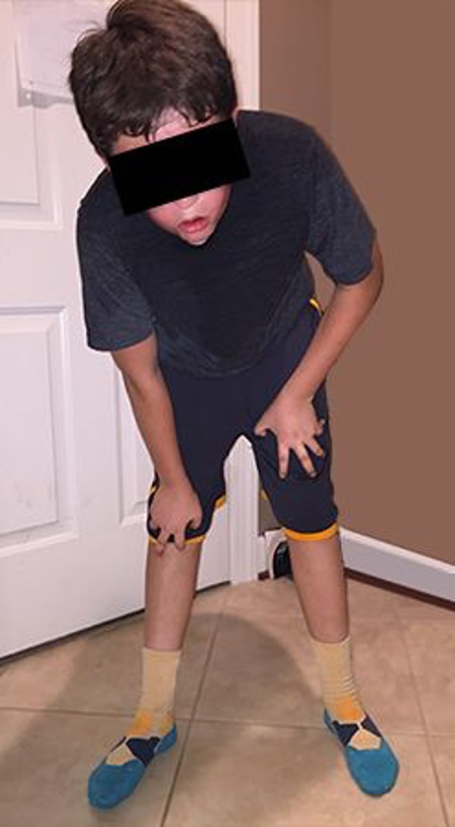 <p>Which of the following factors MOST contributes to the patient's use of the position shown in the photograph forsit-to-stand activities?</p><p>1. Pseudohypertrophy</p><p>2. Proximal weakness</p><p>3. Lordosis</p><p>4. Scoliosis</p>