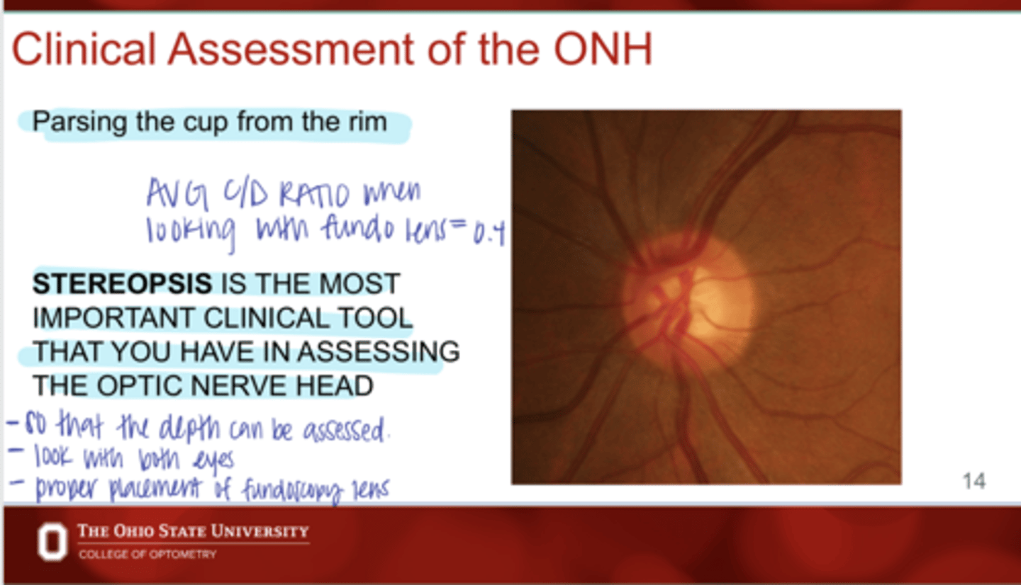 <p>What does stereopsis help evaluate?</p>
