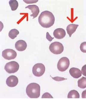 <p><span>cells with distinctive projections, usually two, surrounding an empty area of red cell membrane</span></p>