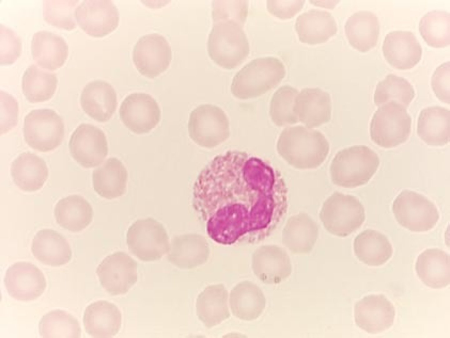 <p>T/F: The distinctive feature of eosinophils is the bright pink cytoplasmic granules</p>