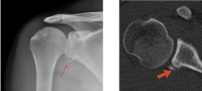 <p>What type of lesion can be seen here? </p>