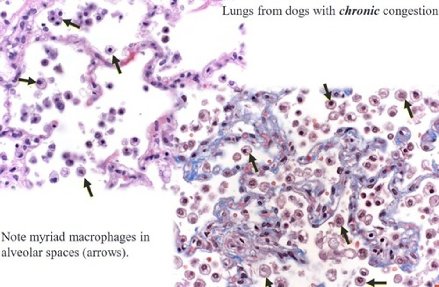 <p>In addition to increased alveolar macrophages containing hemosiderin ----> heart failure cells</p>