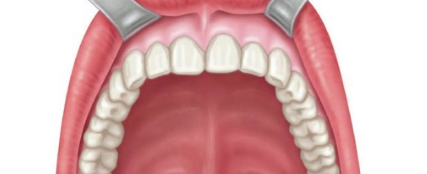 <p>The bony anterior (front) part of the roof of the mouth that separates the oral cavity from the nasal cavity.</p>