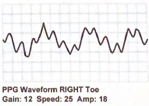 <p>What could improve the following PPG waveform to make it easier to interpret?</p>