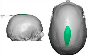 <p>Ridge running lengthwise along top of skull where jaw muscles are attached. Well defined in quadrupeds. Reduced in bipeds.</p>