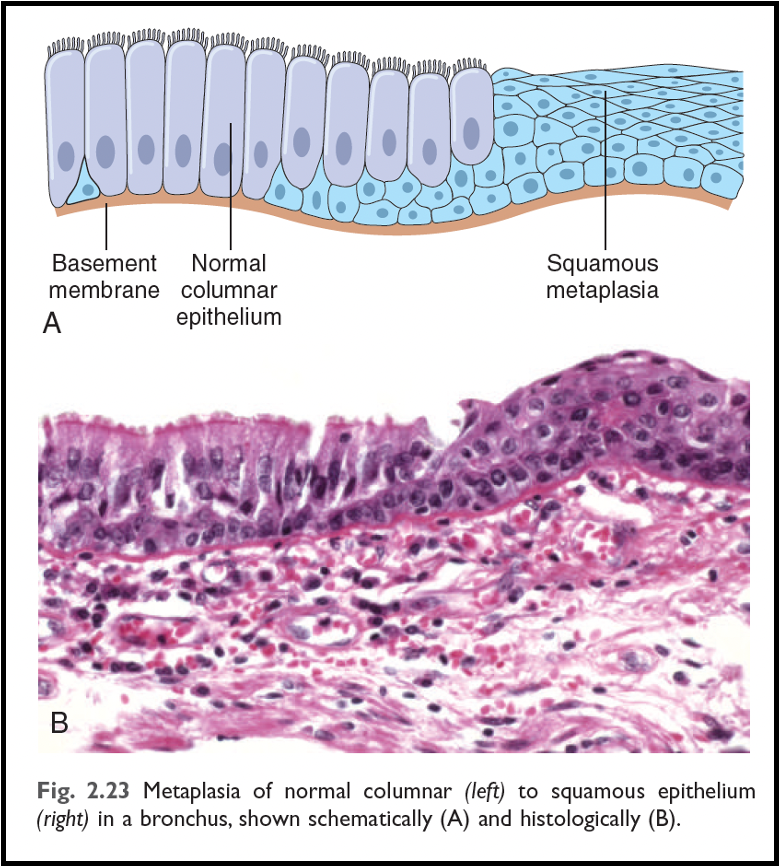<p>outline squamous metaplasia </p>
