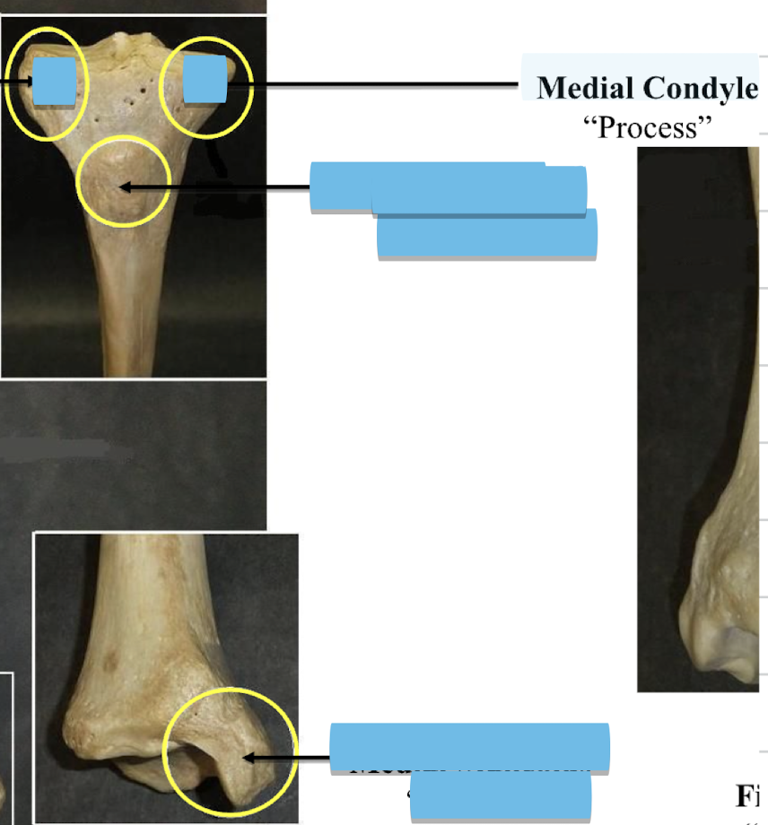 <p>Medial Condyle </p>