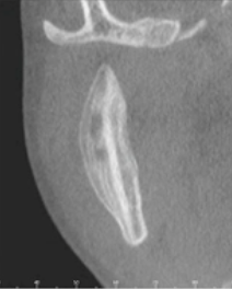<p>how would you describe the appearance of this lesion on the ramus </p>