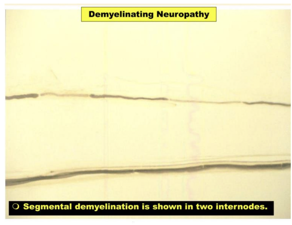 <ul><li><p>involves acute inflammation and demyelination of peripheral sensory and motor fibers</p></li><li><p>occurs within 2 to 3 weeks after a mild infection </p></li><li><p>activates the immune system causing production of an antibody that mistakenly cross-reacts with the myelin sheath (Schwann cells) </p></li><li><p>onset is rapid but followed by plateau then gradual recovery; recovery is usually complete</p></li><li><p>Tx: plasmapheresis and intravenous immunoglobulin therapy, PT/OT</p></li></ul><p></p>