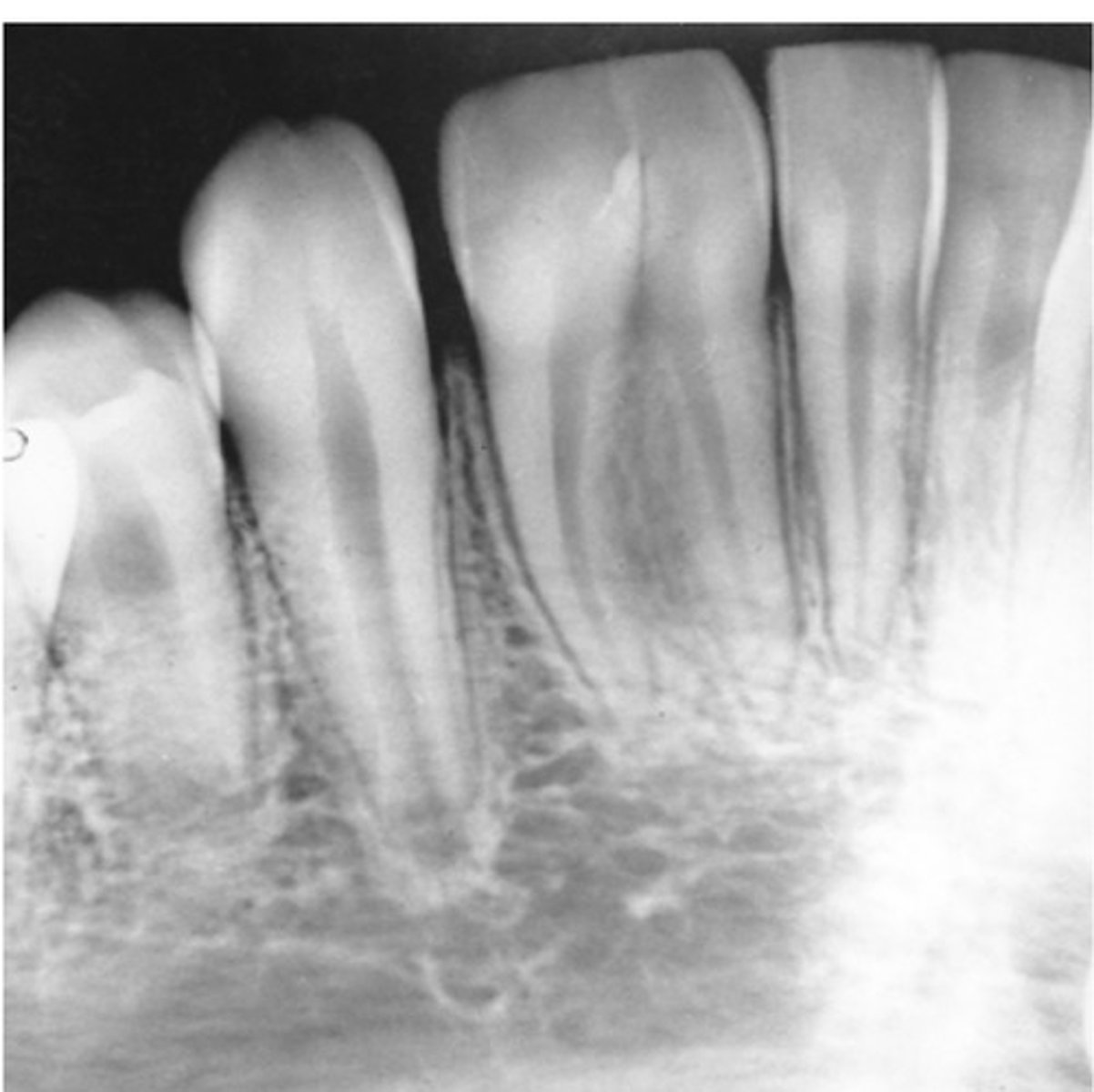 <p>The union of 2 normally separate adjacent tooth germs. Appears as a single large crown that occurs in place of 2 normal teeth. Radiographically, either separate or fused roots and root canals are seen. Patient is usually short one tooth.</p>