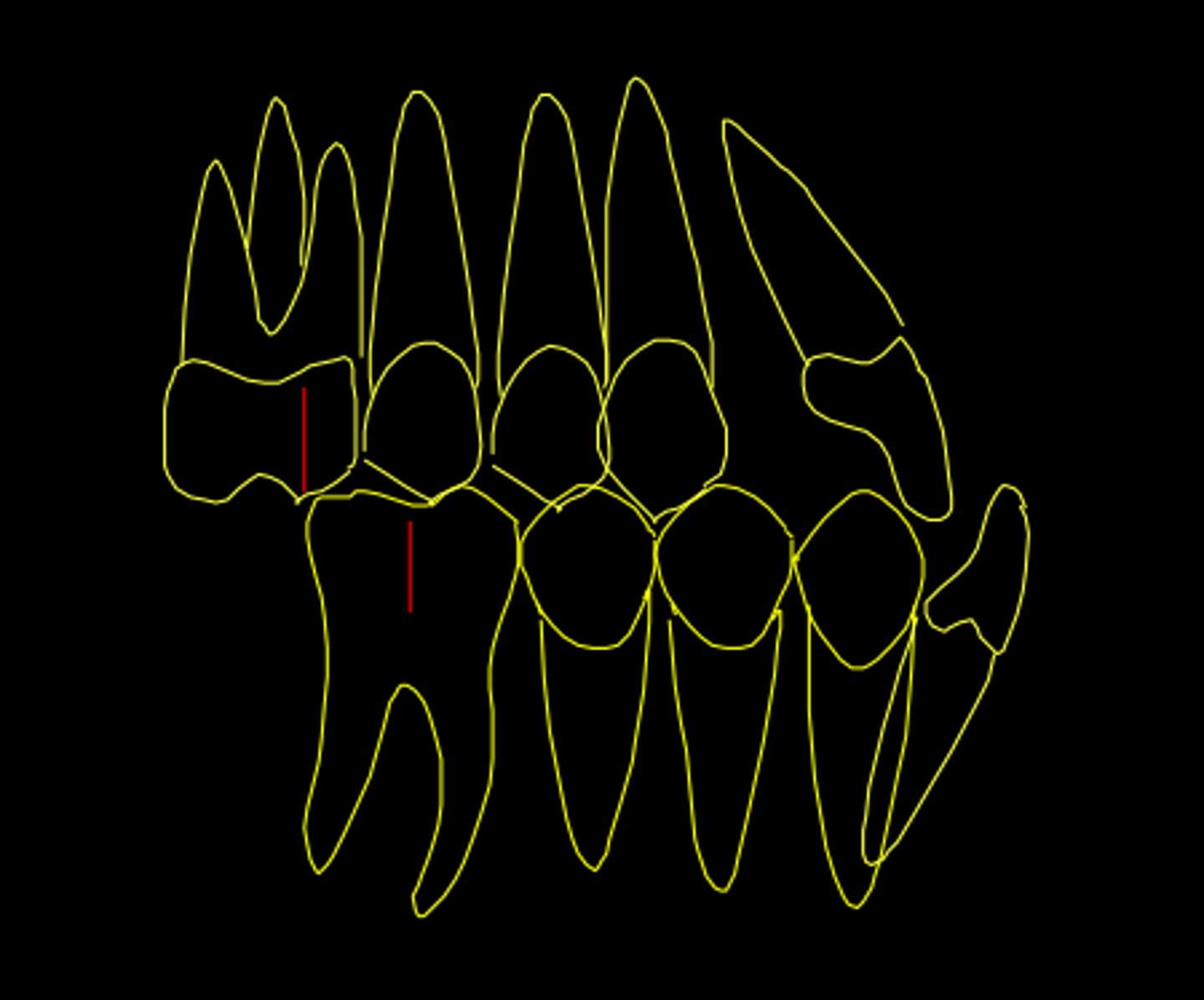 <p>ID the class of occlusion:</p>